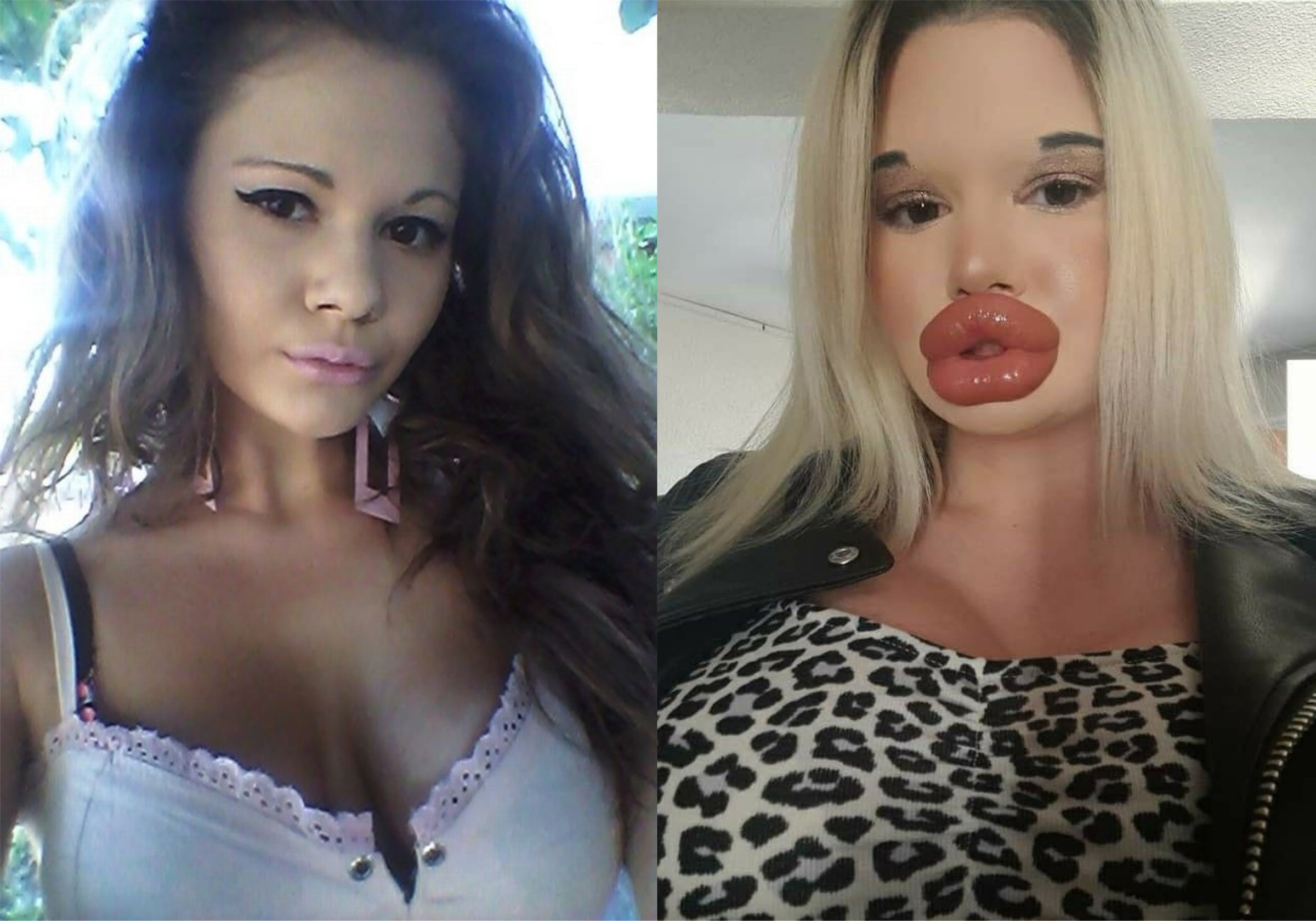 Обезобразили себя филлерами: 8 девушек с самыми большими губами на свете
